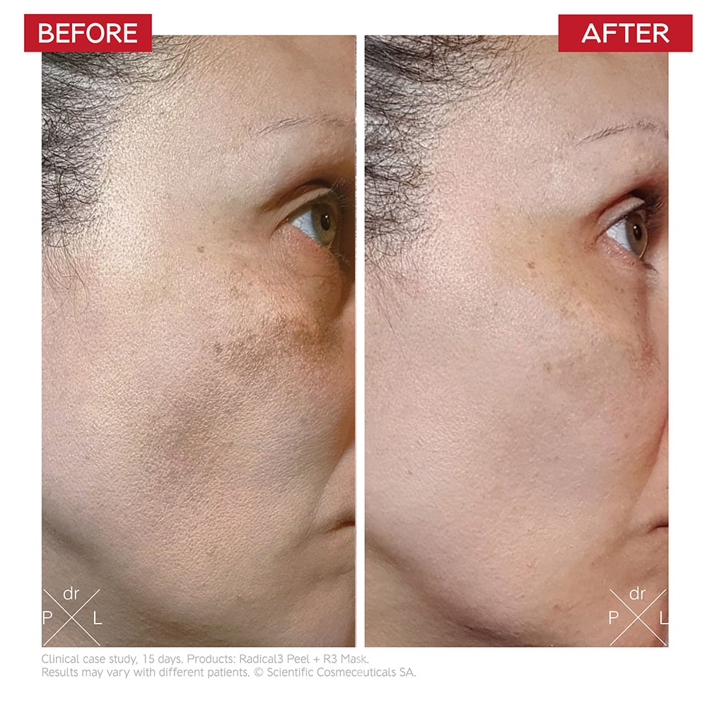 dr-levy-switzerland-skin-care-beauty-product-radical3-reboot-pro-peel-before-after.jpg